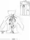 Fig. 02 - INFERIOR VENA CAVA FILTER RETRIEVAL DEVICE AND METHOD OF RETRIEVING SAME