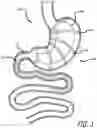 Fig. 02 - Methods And Devices For Anchoring A Gastroenterologic Sleeve