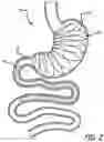 Fig. 03 - Methods And Devices For Anchoring A Gastroenterologic Sleeve