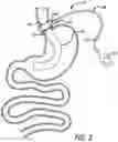 Fig. 04 - Methods And Devices For Anchoring A Gastroenterologic Sleeve