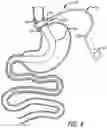 Fig. 05 - Methods And Devices For Anchoring A Gastroenterologic Sleeve