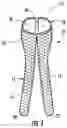 Fig. 02 - Bifurcated medical device for treating a target site and associated method