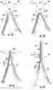 Fig. 07 - Bifurcated medical device for treating a target site and associated method