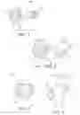 Fig. 02 - Ligament fixation device and method