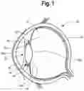 Fig. 02 - Intraocular lens and methods for implanting the same