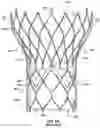Fig. 02 - Attachment of leaflets to prosthetic heart valve