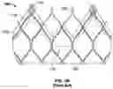 Fig. 03 - Attachment of leaflets to prosthetic heart valve