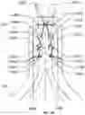 Fig. 05 - Attachment of leaflets to prosthetic heart valve