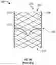 Fig. 07 - Attachment of leaflets to prosthetic heart valve
