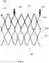 Fig. 08 - Attachment of leaflets to prosthetic heart valve