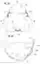 Fig. 09 - Prosthetic heart valve