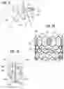 Fig. 12 - Prosthetic heart valve