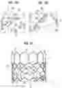 Fig. 07 - Prosthetic heart valve