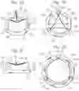 Fig. 03 - Assembly of heart valves and intermediate adapter stent