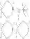 Fig. 10 - Assembly of heart valves and intermediate adapter stent