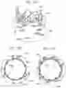 Fig. 16 - Assembly of heart valves and intermediate adapter stent