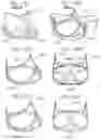 Fig. 18 - Assembly of heart valves and intermediate adapter stent