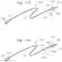 Fig. 20 - Assembly of heart valves and intermediate adapter stent