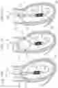 Fig. 22 - Assembly of heart valves and intermediate adapter stent