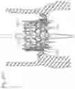 Fig. 26 - Assembly of heart valves and intermediate adapter stent