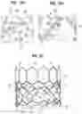 Fig. 07 - Prosthetic heart valve