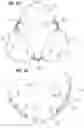 Fig. 09 - Prosthetic heart valve