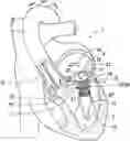 Fig. 01 - Transcatheter atrio-ventricular valve prosthesis