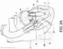 Fig. 03 - Transcatheter atrio-ventricular valve prosthesis