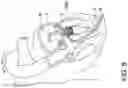 Fig. 10 - Transcatheter atrio-ventricular valve prosthesis