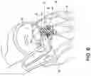 Fig. 11 - Transcatheter atrio-ventricular valve prosthesis