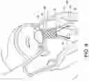 Fig. 14 - Transcatheter atrio-ventricular valve prosthesis