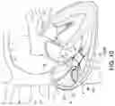 Fig. 15 - Transcatheter atrio-ventricular valve prosthesis