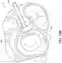 Fig. 18 - Transcatheter atrio-ventricular valve prosthesis