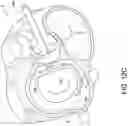 Fig. 19 - Transcatheter atrio-ventricular valve prosthesis