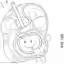 Fig. 20 - Transcatheter atrio-ventricular valve prosthesis