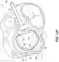 Fig. 22 - Transcatheter atrio-ventricular valve prosthesis