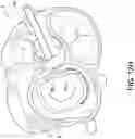 Fig. 24 - Transcatheter atrio-ventricular valve prosthesis