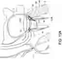 Fig. 27 - Transcatheter atrio-ventricular valve prosthesis