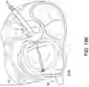 Fig. 30 - Transcatheter atrio-ventricular valve prosthesis