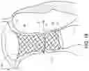 Fig. 31 - Transcatheter atrio-ventricular valve prosthesis