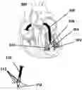 Fig. 01 - Method of improving cardiac function