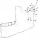 Fig. 01 - Temporomandibular joint implants and methods of treating a temporomandibular joint