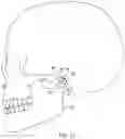 Fig. 12 - Temporomandibular joint implants and methods of treating a temporomandibular joint