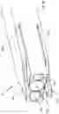 Fig. 64 - Spinal fusion device with staged expansion