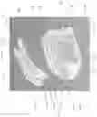 Fig. 87 - Spinal implant device