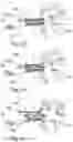 Fig. 06 - PERCUTANEOUS HEART VALVE