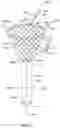 Fig. 06 - Repositionable and removable stents