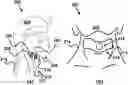 Fig. 01 - Device and method for correcting obstructive sleep apnea
