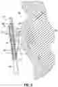 Fig. 05 - Instruments For Removing Debris From An Eye