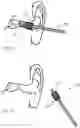 Fig. 03 - Apparatus and method for treating or/and refreshing an ear canal